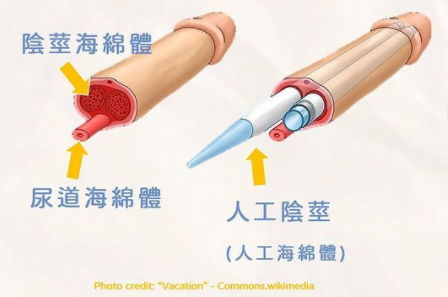 人工海綿體