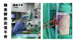 精索靜脈曲張手術