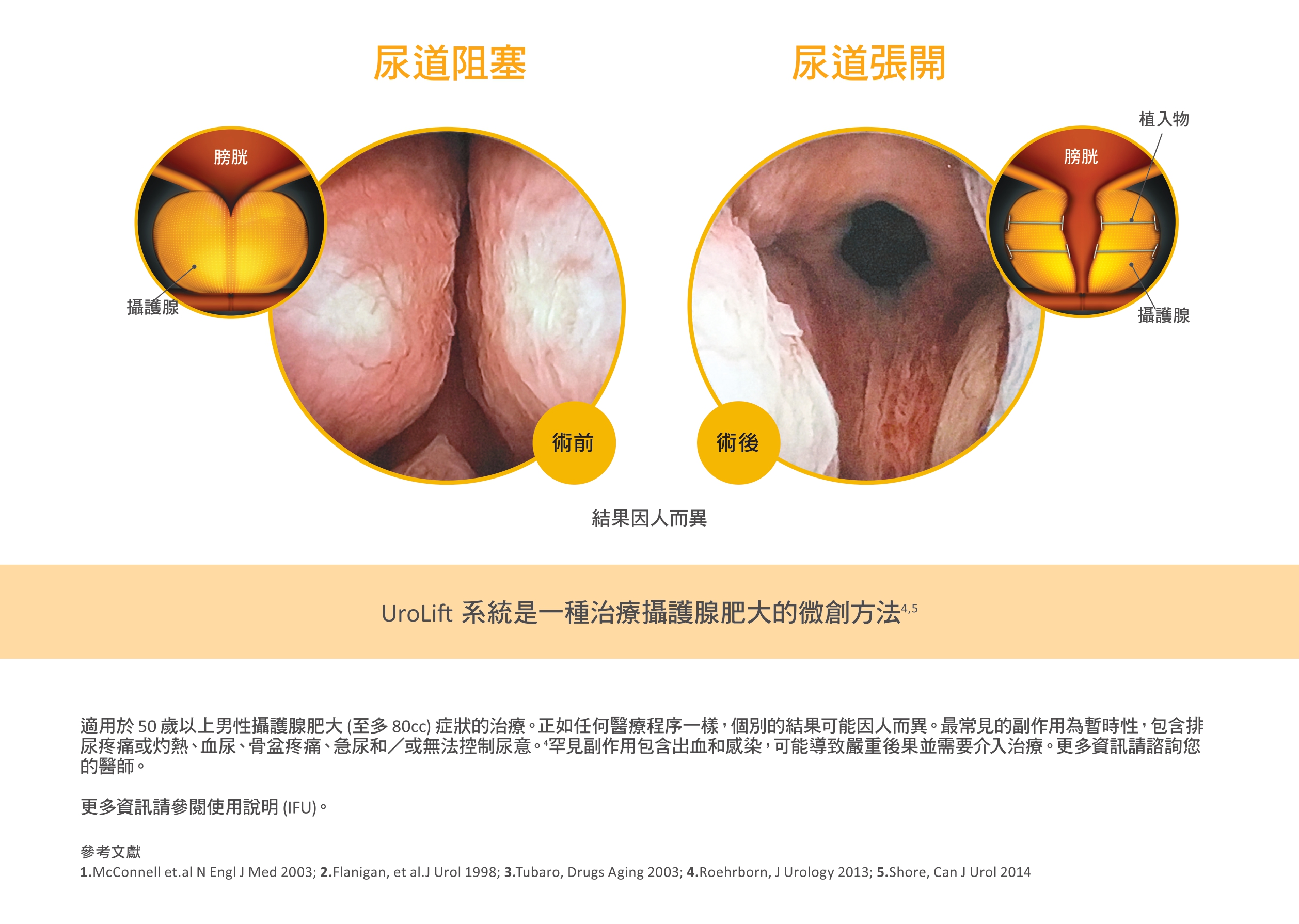 攝護腺拉開術前術後對比