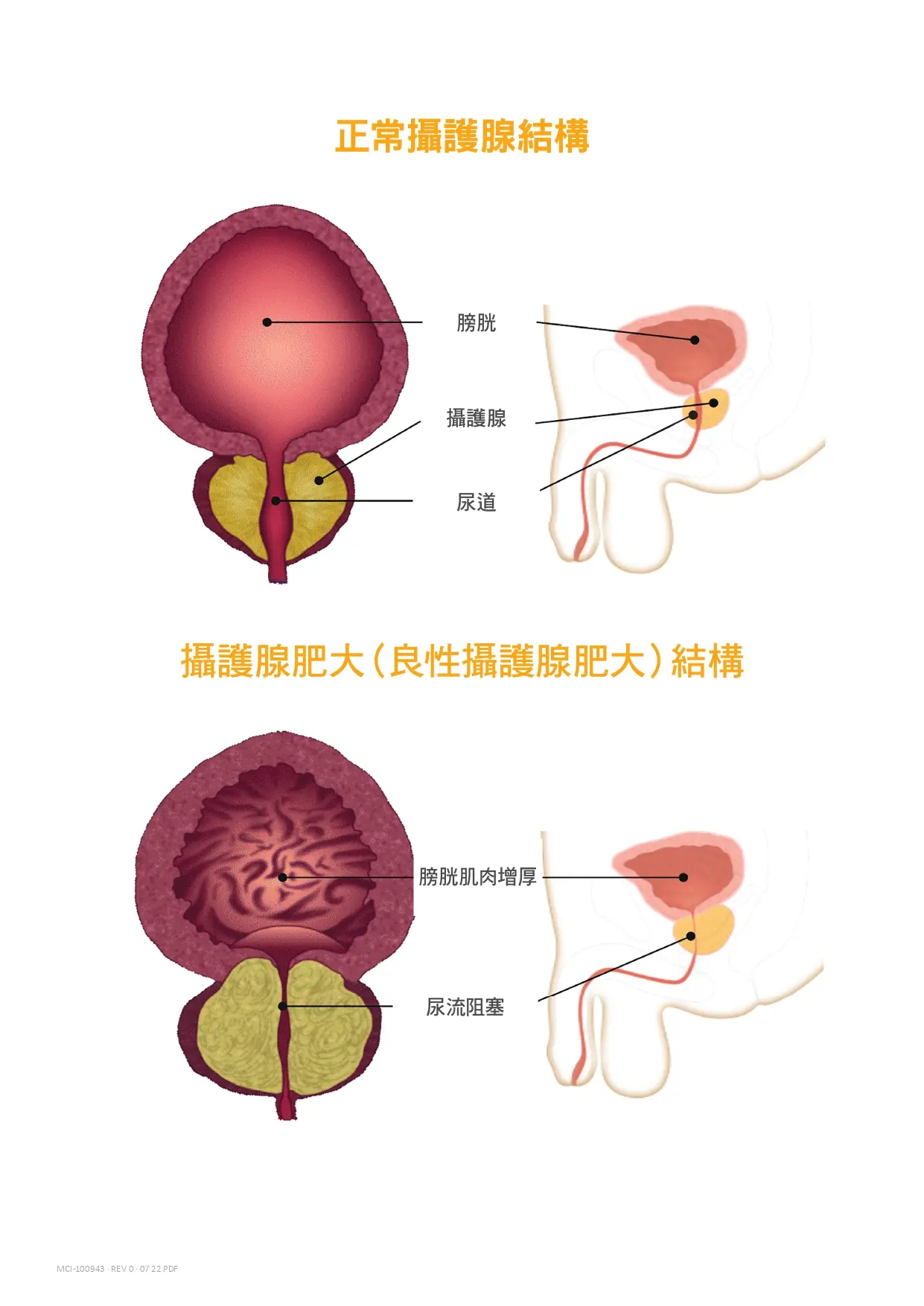 正常攝護腺對比攝護腺肥大