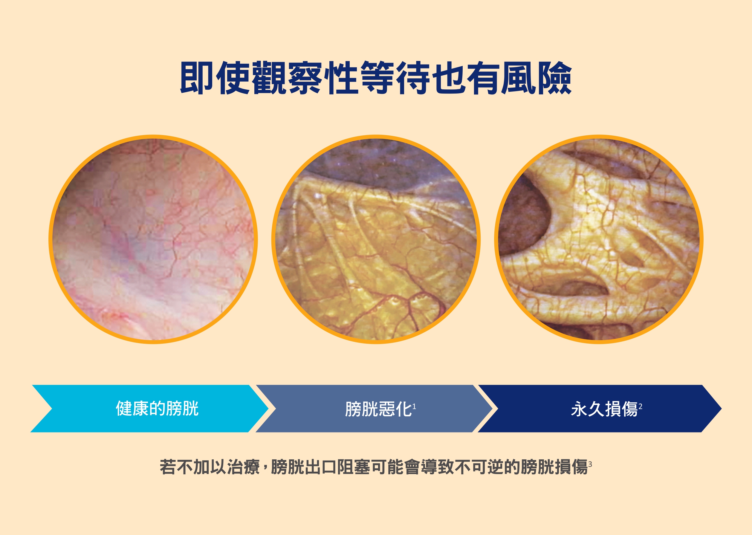 膀胱惡化三階段