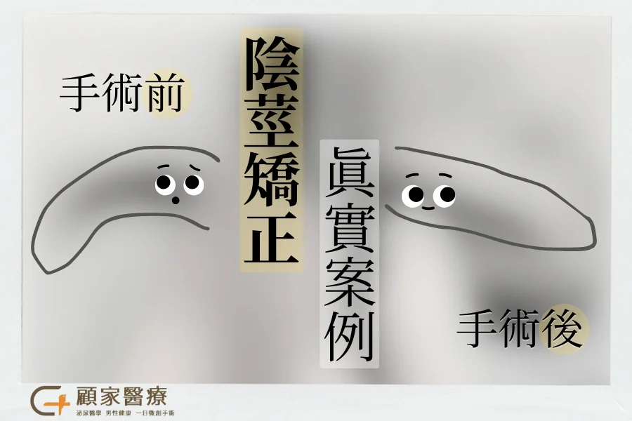 雞雞彎曲的手術效果示意，原本是左彎綜合下彎，手術後有筆直許多