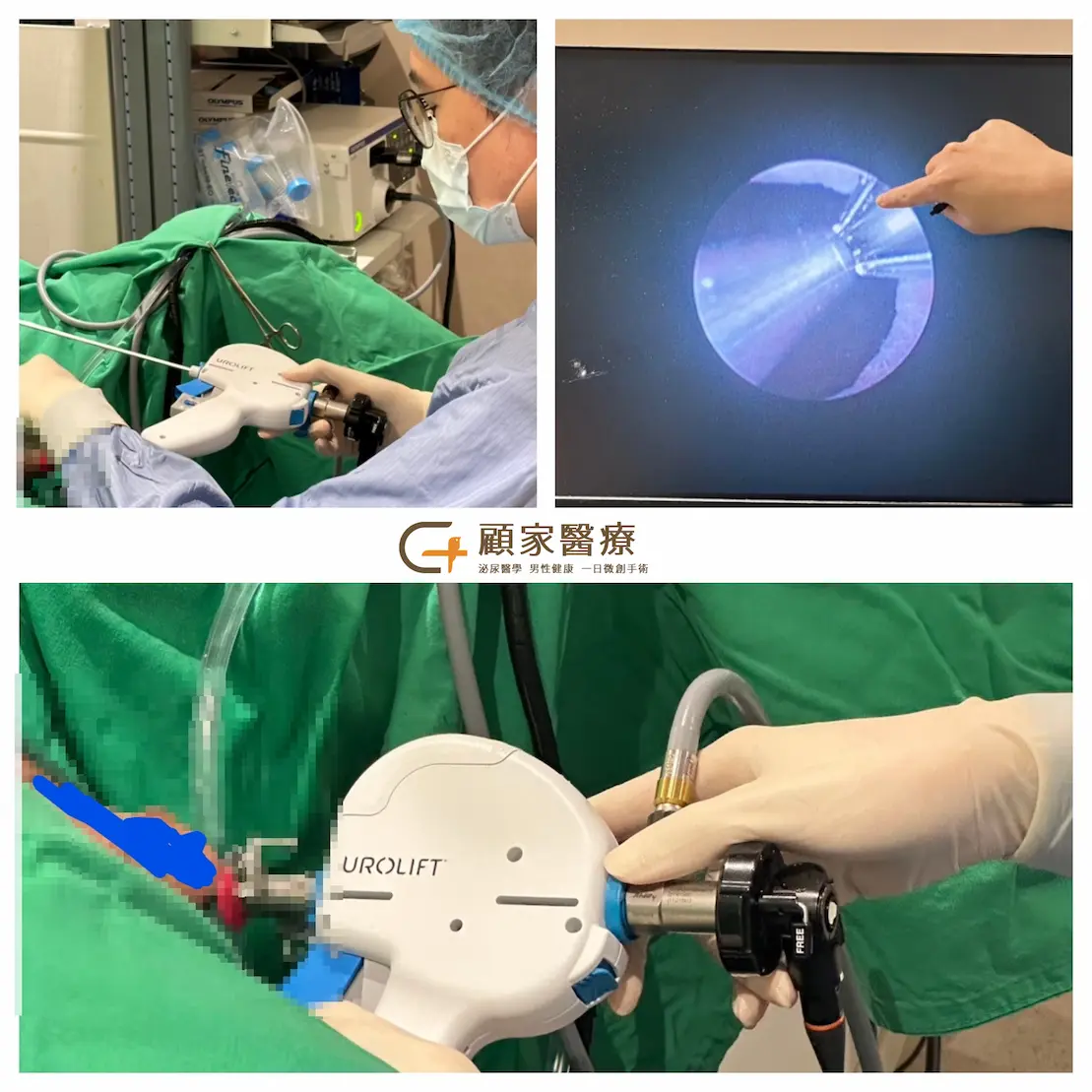 攝護腺拉提術urolift