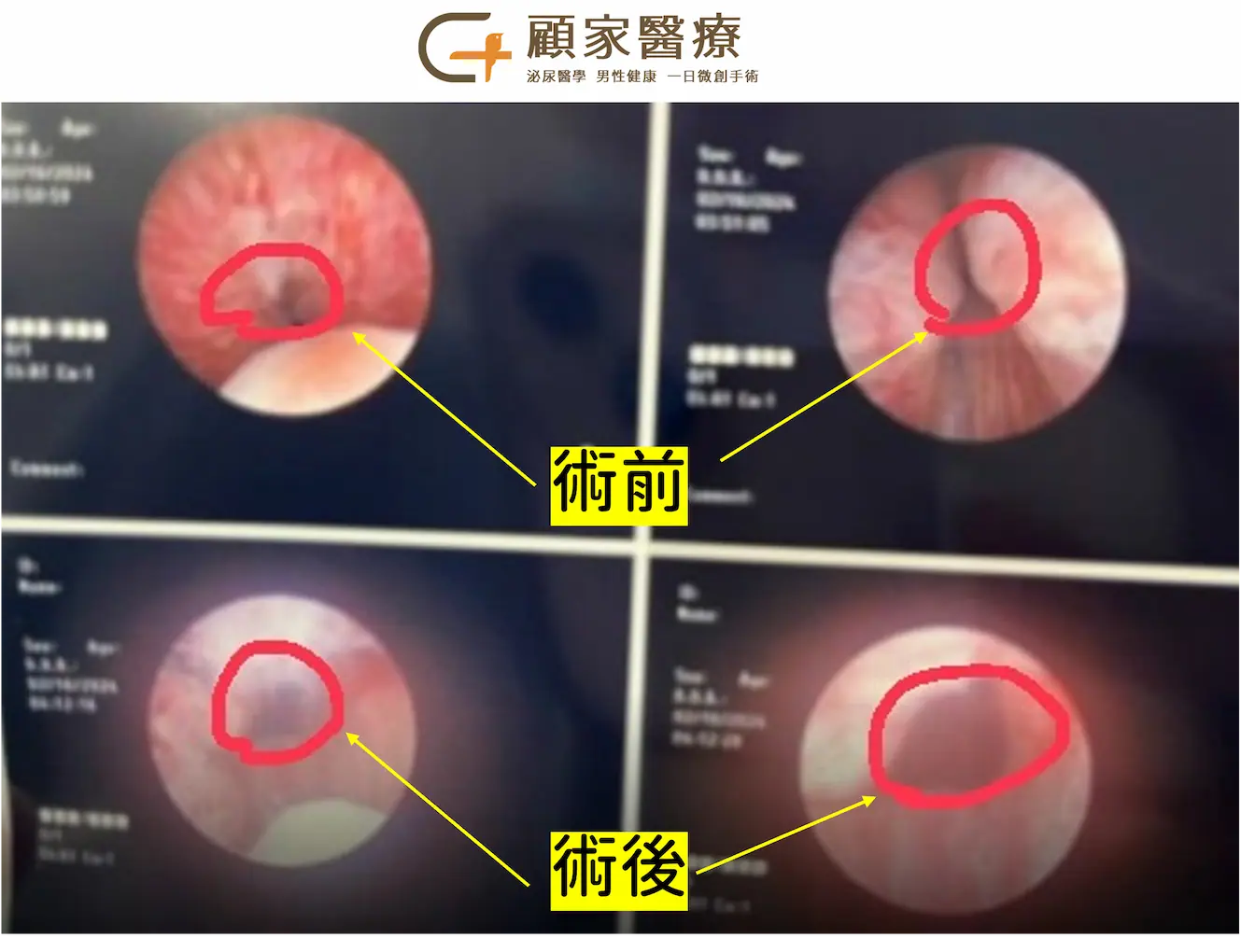 顧家泌尿科 攝護腺拉提術urolift術前術後畫面