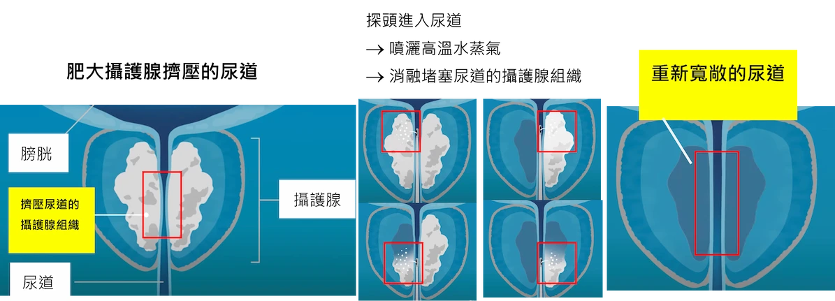 微創攝護腺水蒸氣消融療法的作用原理