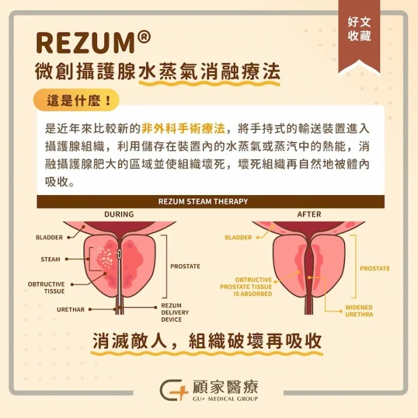 攝護腺肥大要開刀嗎,了解微創攝護腺水蒸氣消融療法