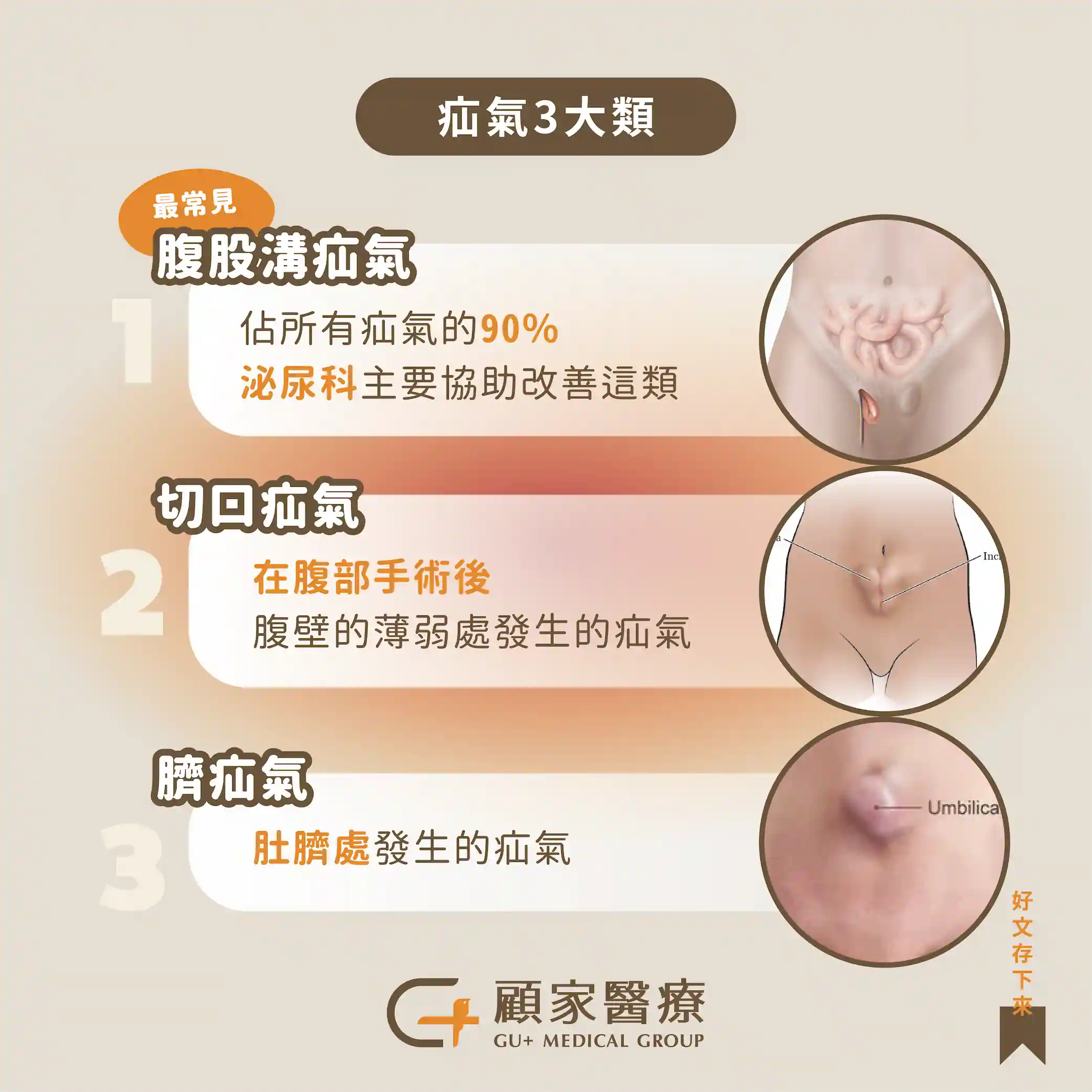 三種疝氣種類