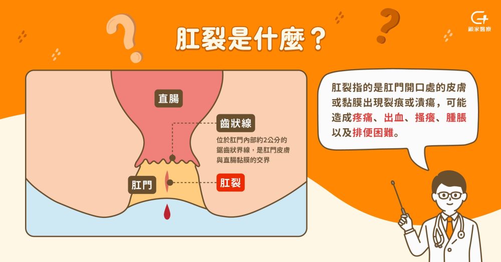 肛裂是什麼?