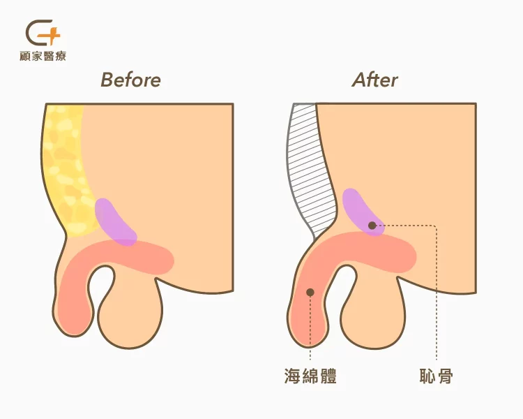 抽脂增長陰莖比較