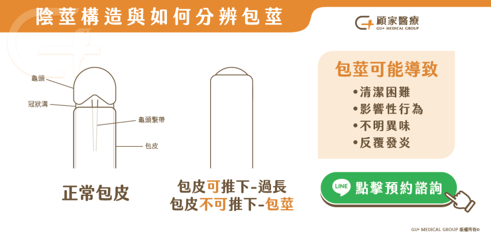包皮過長要開刀嗎？如何辨認是不是包莖？割包皮找顧家醫療