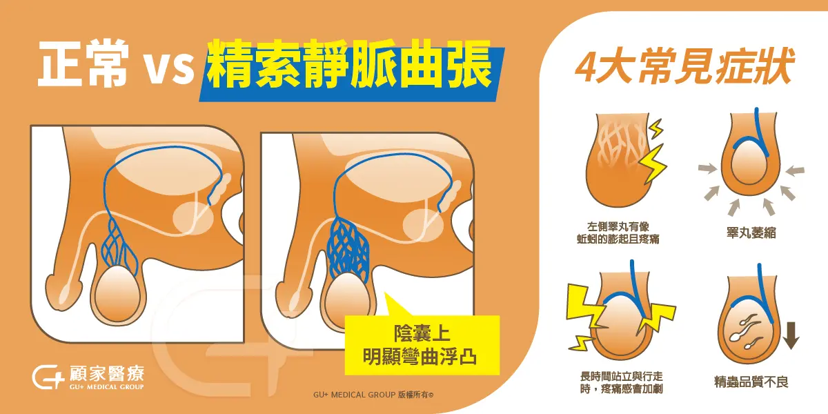 精索靜脈曲張四大常見症狀