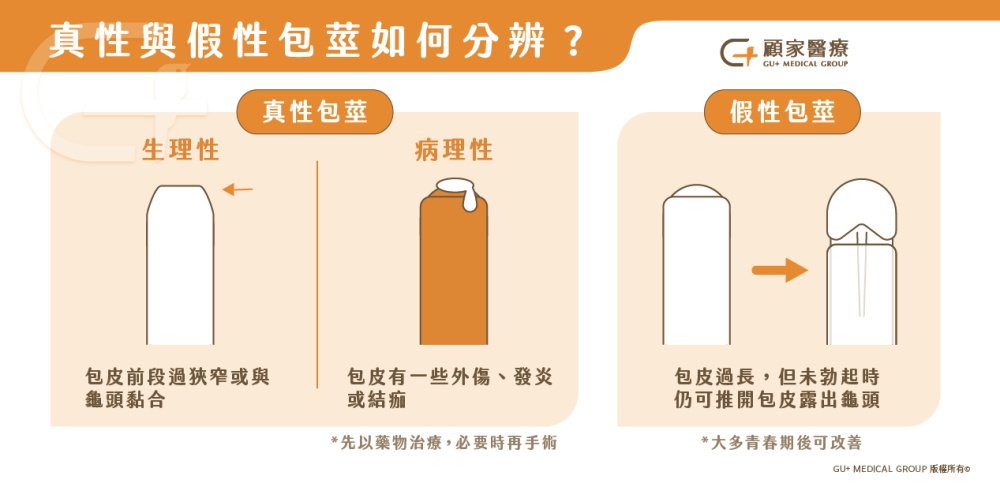 包皮過長一定要割嗎？三大狀況割包皮找顧家醫療