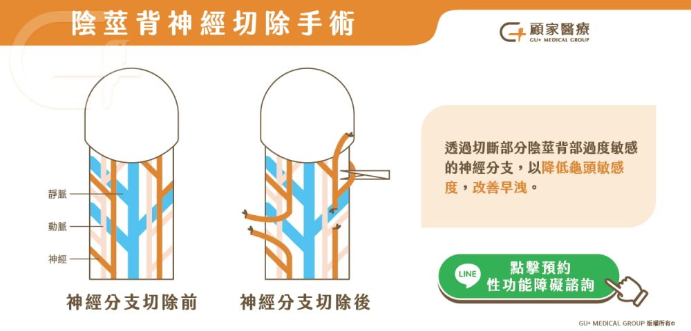 陰莖背神經切除手術