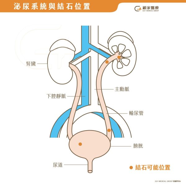 泌尿系統與結石位置
