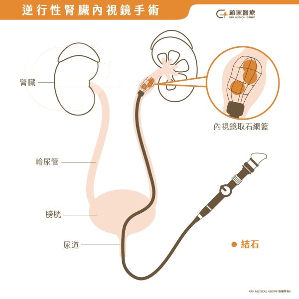 逆行性腎臟內視鏡手術