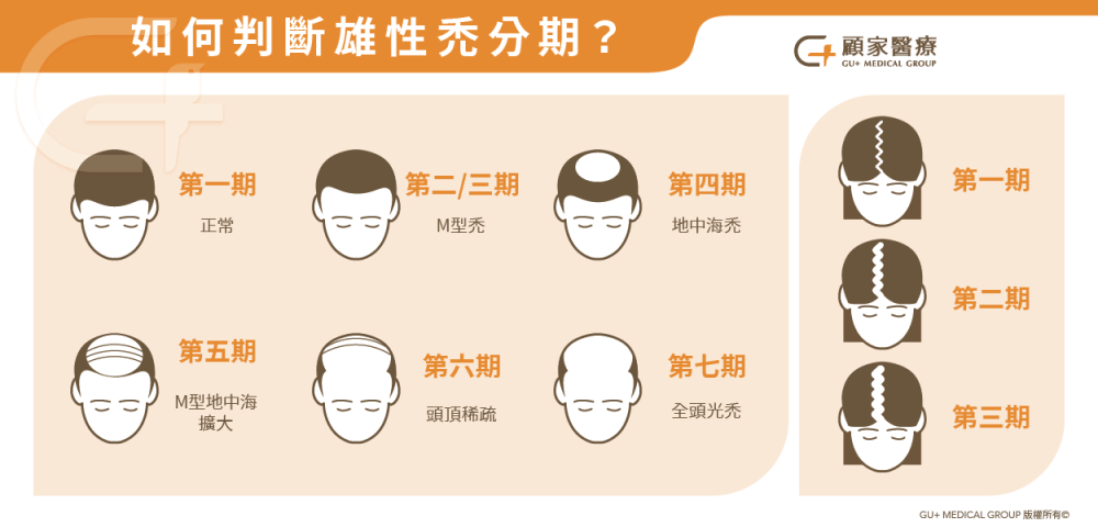雄性禿分期