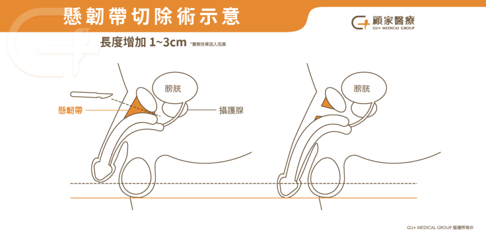 懸韌帶切除術示意