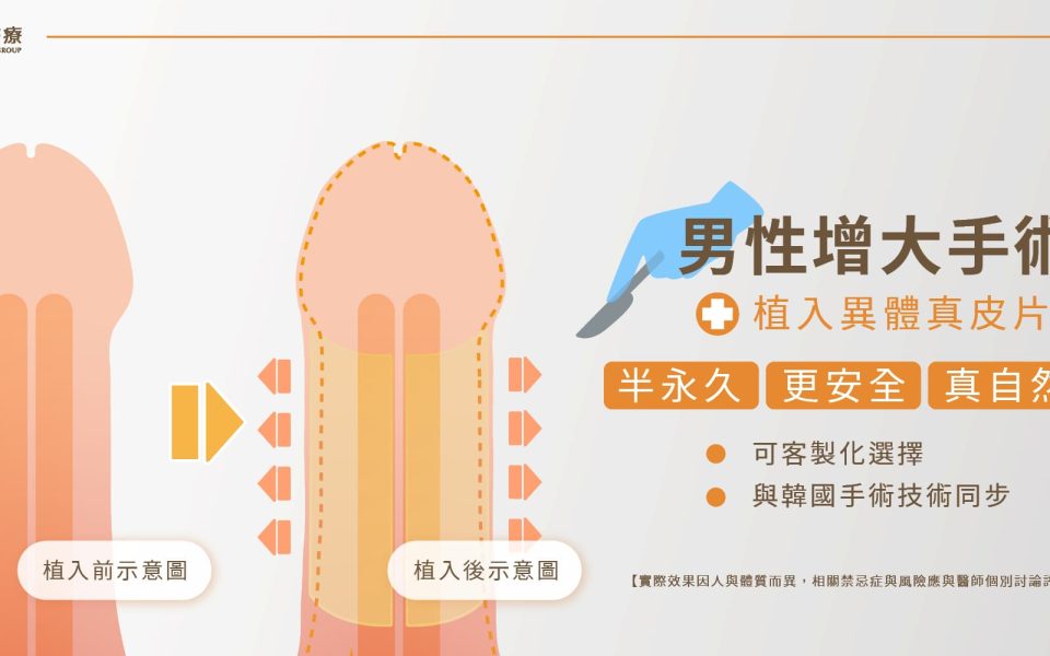 男性增大手術怎麼做