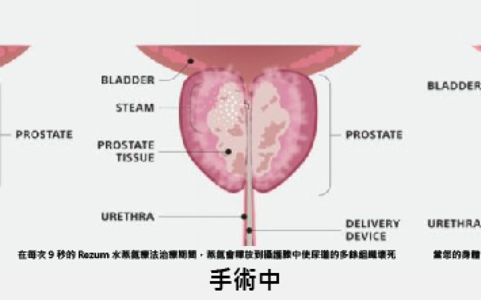 攝護腺肥大-水蒸氣消融治療