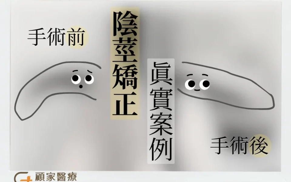 雞雞彎曲的手術效果示意，原本是左彎綜合下彎，手術後有筆直許多